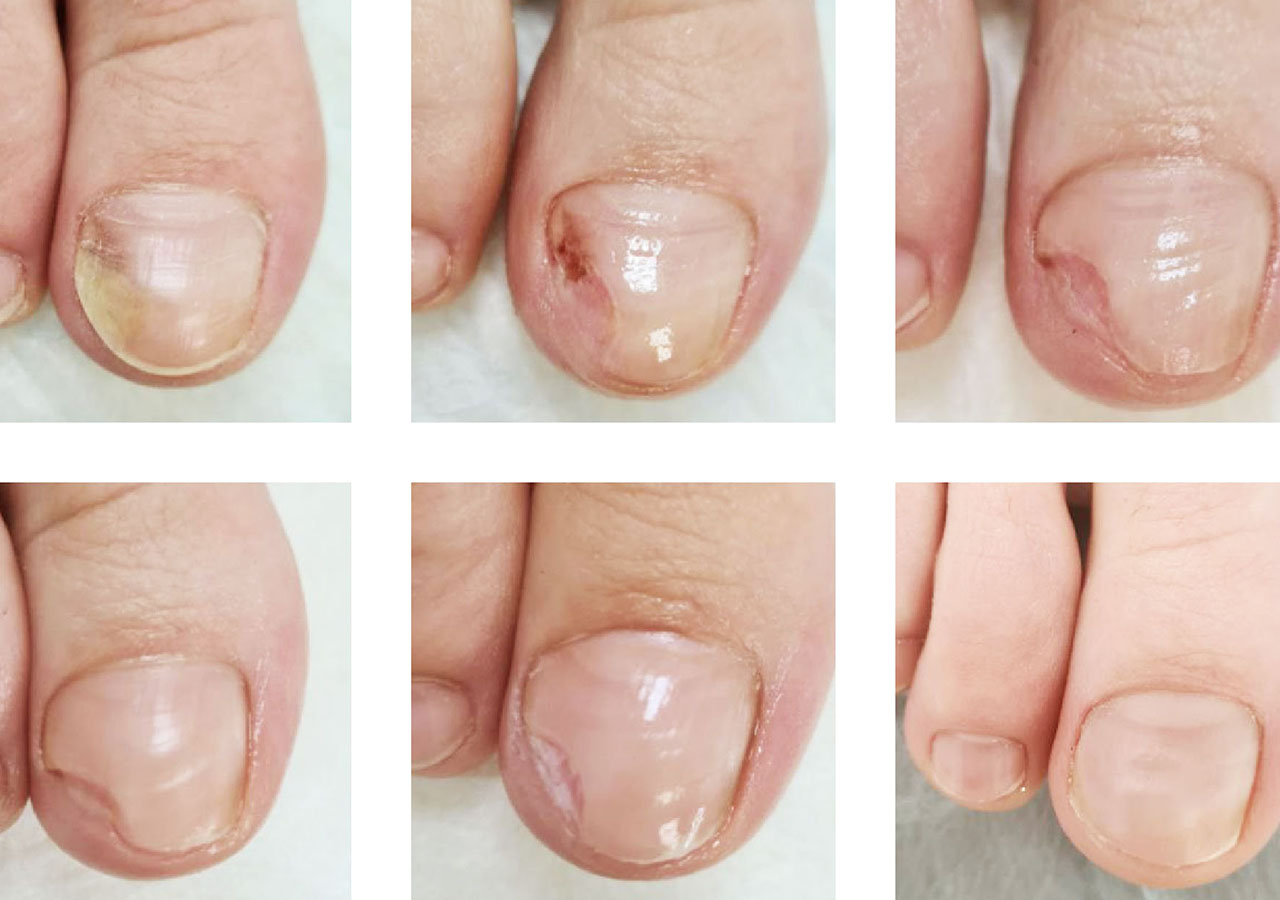 imagenes_servicios_ppp_onicomicosis